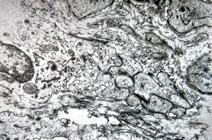 F,25y. | giant multinuclear osteoclast - aneurysmatic cyst - tibia